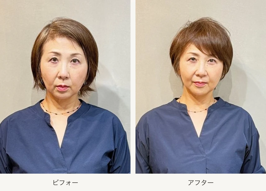 ハチ周りと顔周りのシルエットを正面から比較したビフォーアフター。左が施術前、右が施術後のショートヘア。